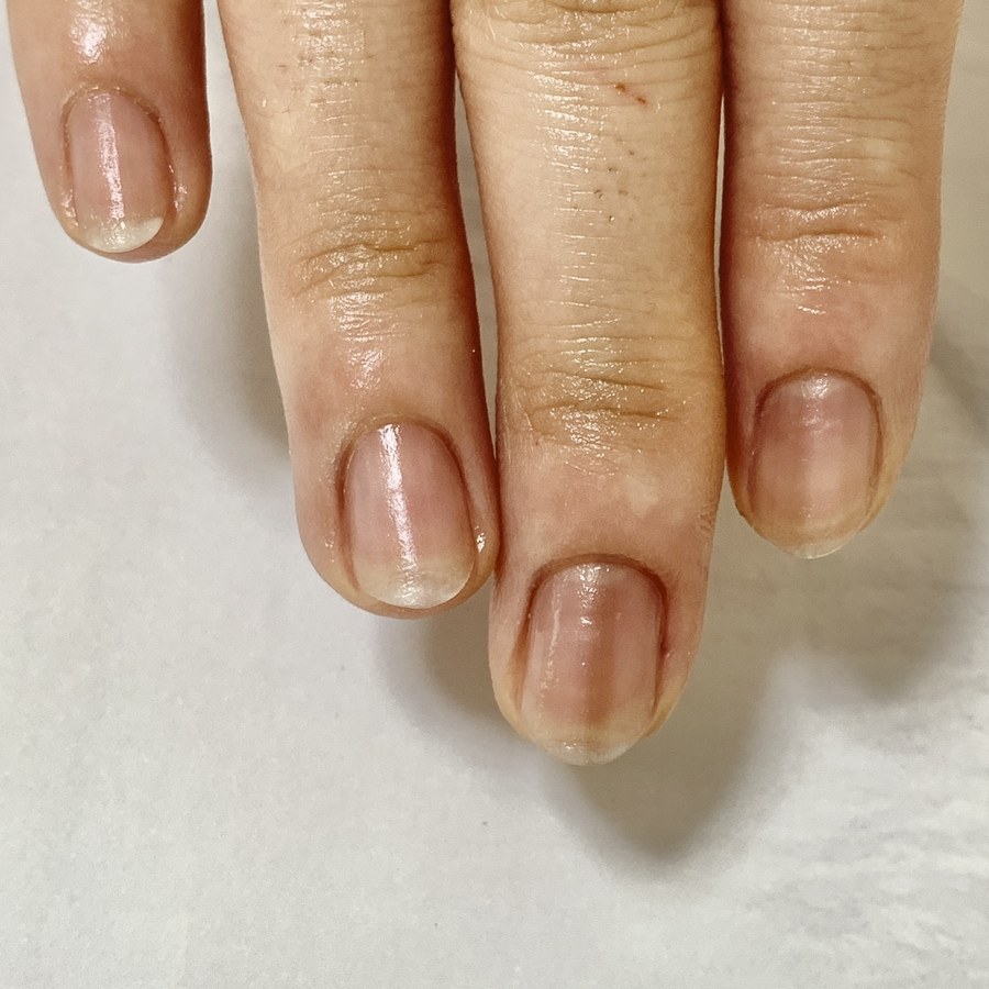 2ヶ月後。表面がなめらかになり、健やかに伸びた4本の指の自爪