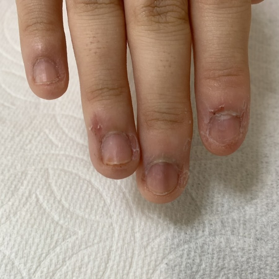 ケア前。爪まわりの皮膚が荒れ、爪の表面もボコボコになっている4本の指
