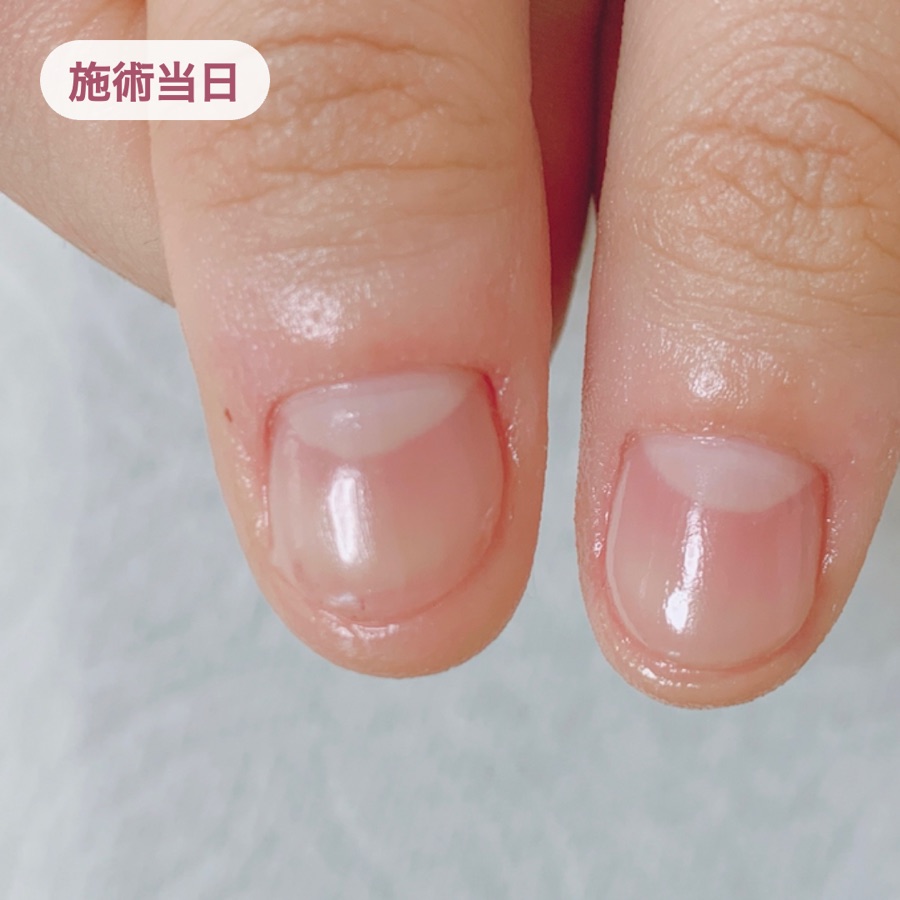 施術当日。甘皮と爪まわりを整え、ジェルで保護した状態の爪
