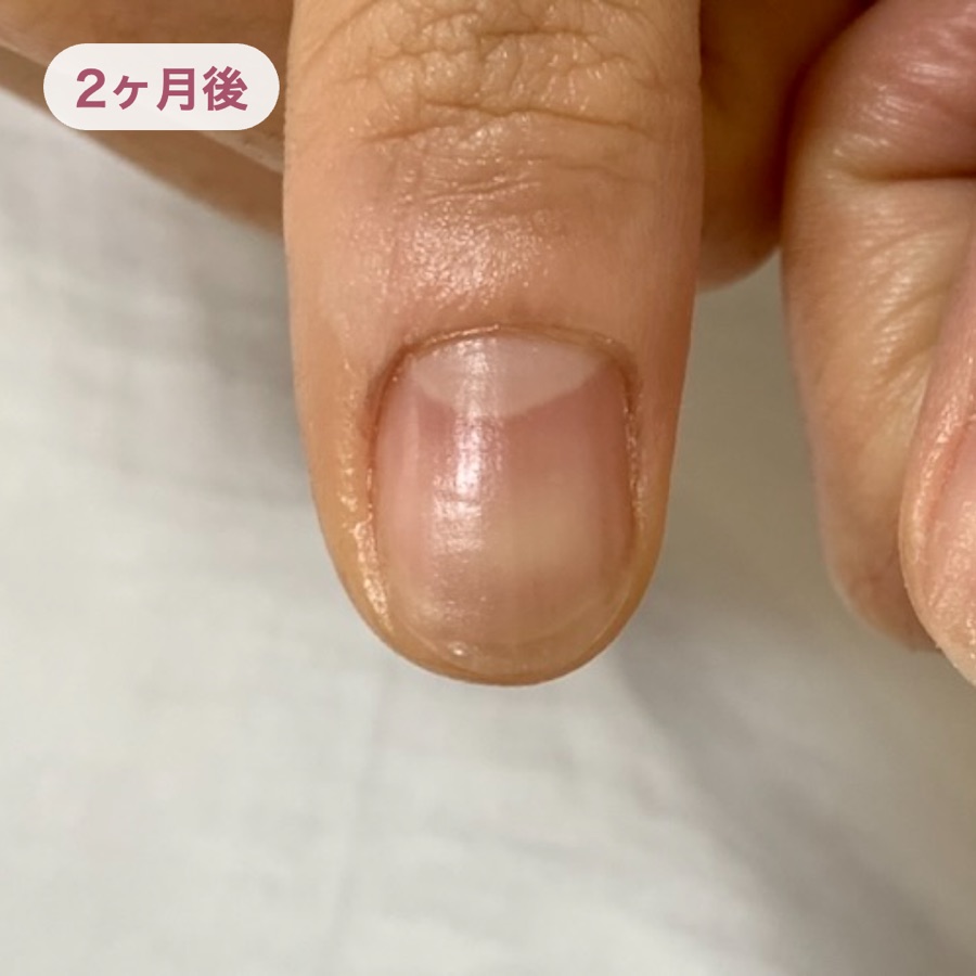 2ヶ月後、ジェルをオフした状態の自爪。表面がなめらかになり、健やかに伸びてきた爪